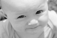 Атопический дерматит