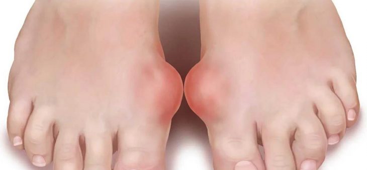 Что такое подагра и как ее лечить?