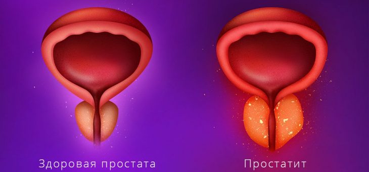 Простатит: симптомы, причины, лечение