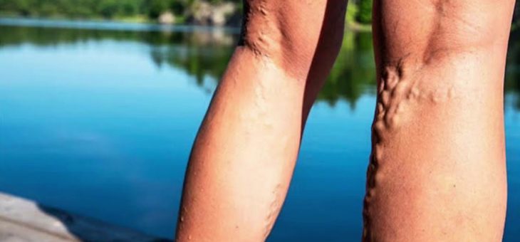 Варикозное расширение вен